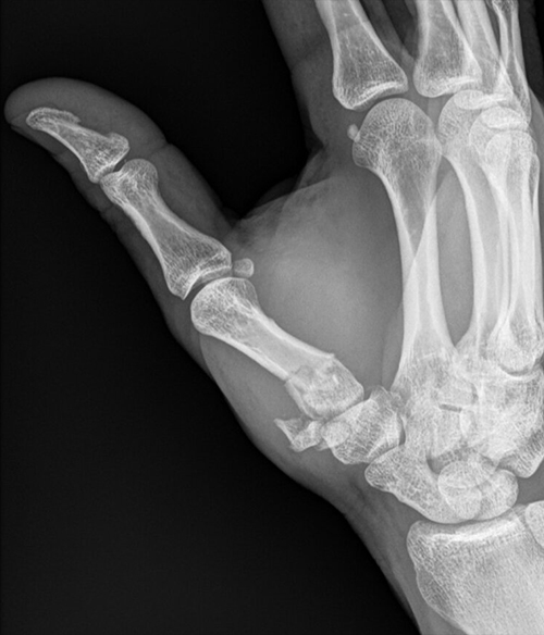 Broken Thumb Tip X Ray