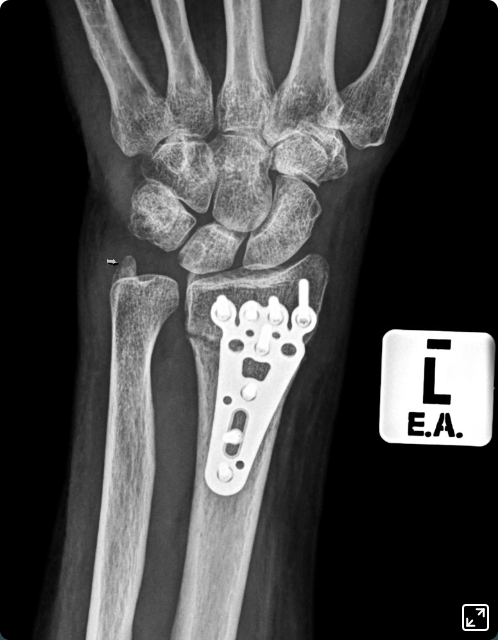 Broken Wrist Bones Xray