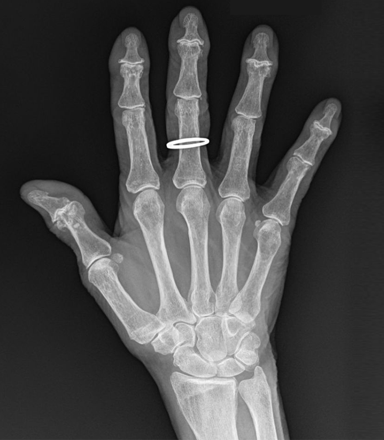 DIP Arthritis Pre Op