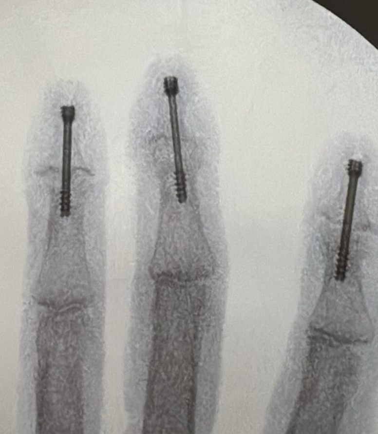 DIP Arthrodesis Post Op