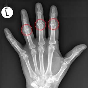 pip-arthritis-img