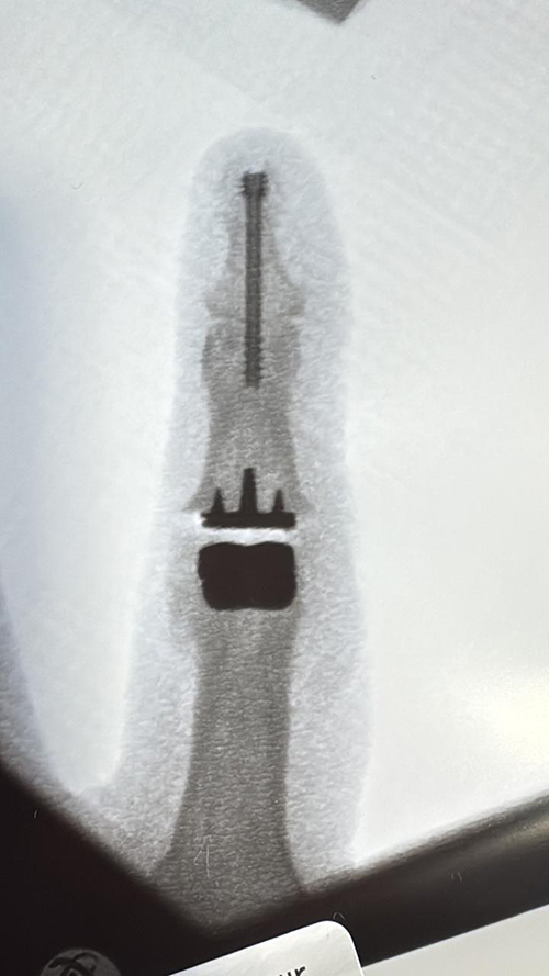 PIP Replacement Post Op