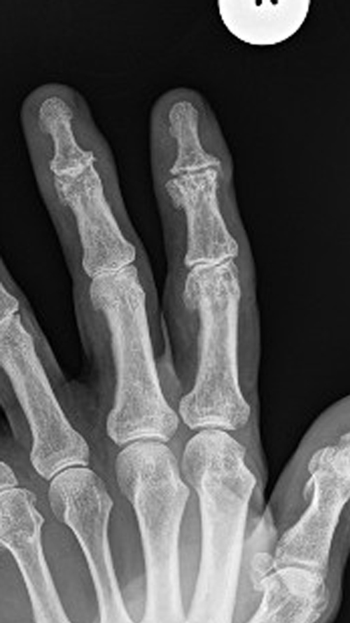 PIP Replacement Pre Op