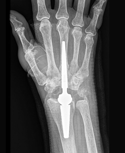 Total Wrist Replacement Post Op