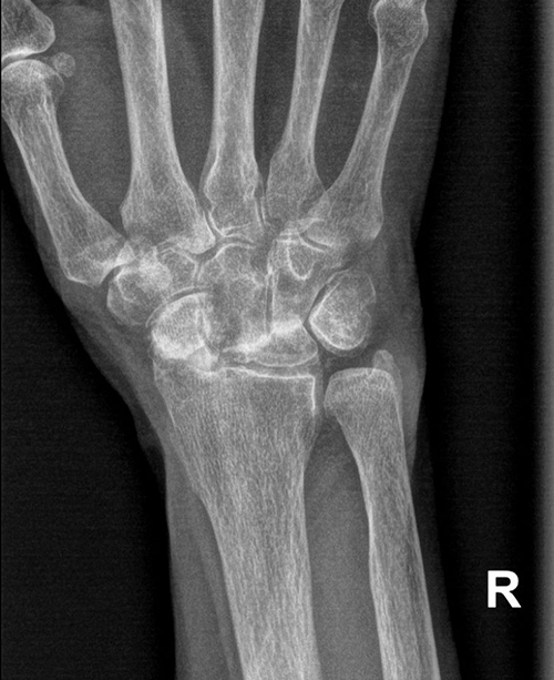 Total Wrist Replacement Pre Op