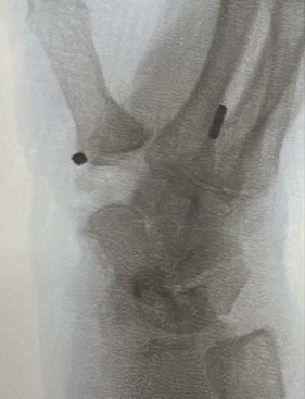 Trapeziectomy and Suspension Plasty Post Op